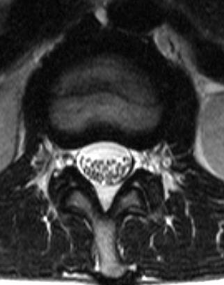                   МРТ (аксиальная томограмма)