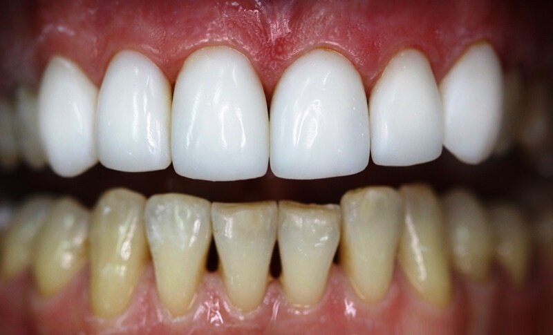 Виниры! На верхние зубы поставлены виниры. Далее будет уставка на нижнюю челюсть.