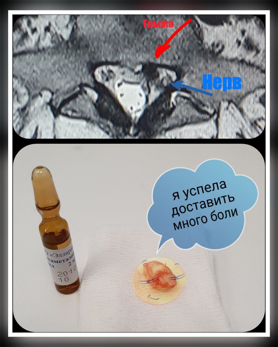 Грыжа позвонка на снимке МРТ.