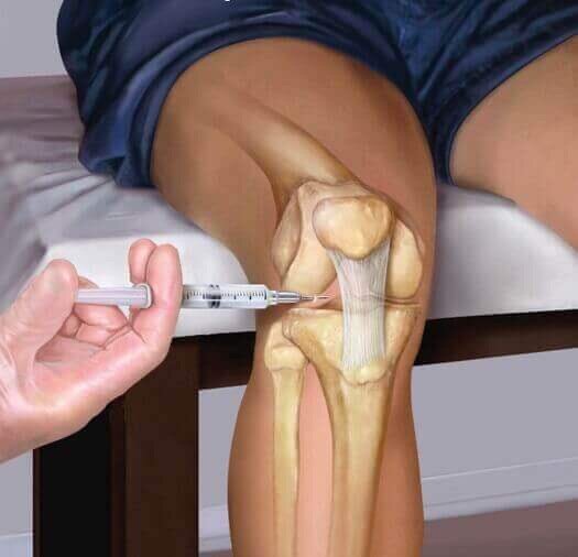 Инъекция гиалуроновой кислоты в коленный сустав