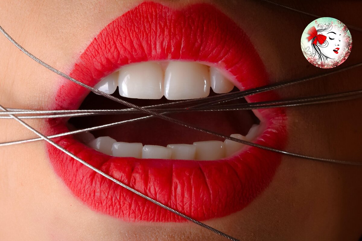 Все о брекетах