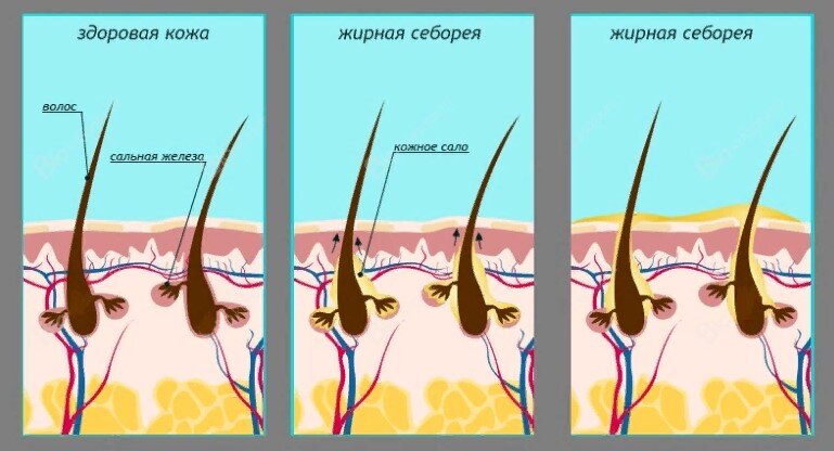 Себорея: причины, классификация, лечение