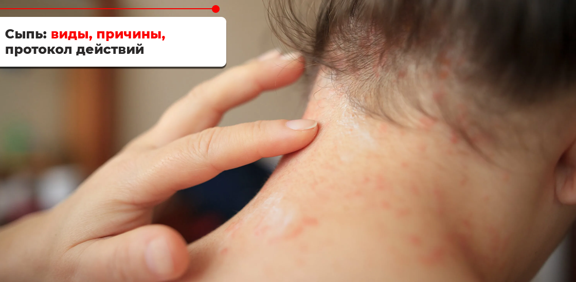 Кожная сыпь является одним из самых распространенных дерматологических симптомов. Сыпью называют поражение кожи в виде различных высыпаний: пузырьков, гнойничков, пятен, узелков, пурпур.