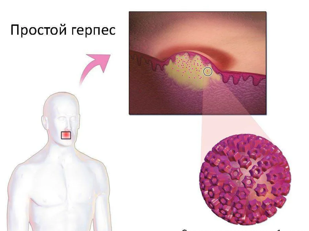 Вирус герпеса
