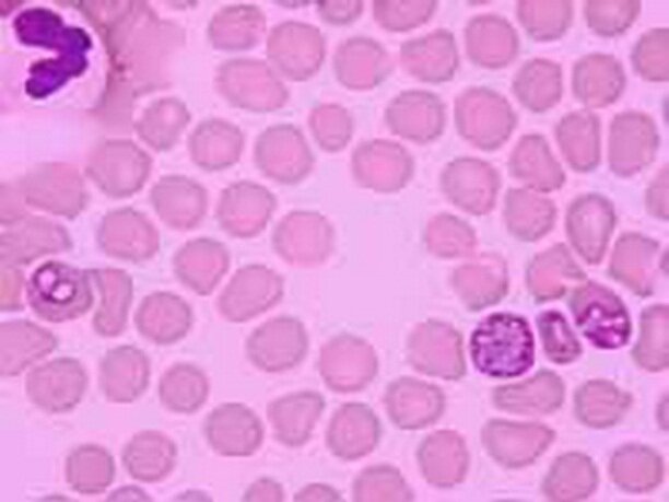 Так выглядят зараженные бабезиями эритроициты