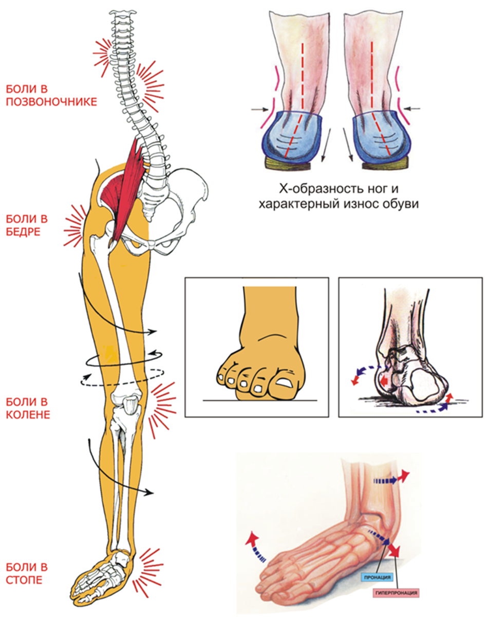 Ломит ногу от колена до стопы. Болит внутренняя лодыжка. Седалищный нерв схема расположения. Остеопороз нижних конечностей. Косточки на стопе от высоких каблуков.