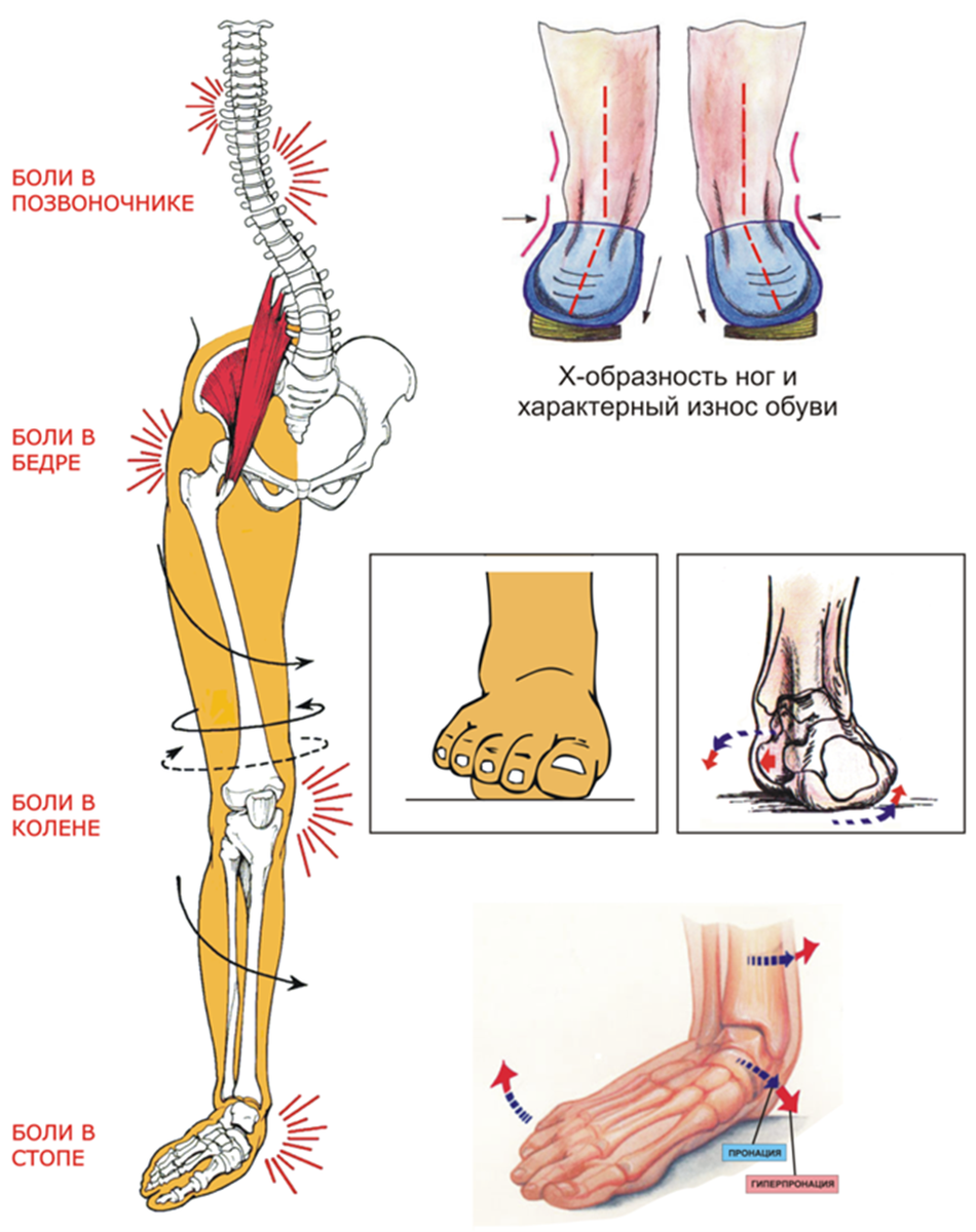Почему болят ноги от колен до ступней. Плоскостопие вид сбоку. Плоскостопие и болезнь костей. Плоскостопие пронация стопы.