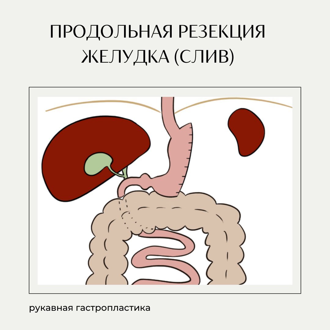 Последствия резекции желудка. Резекция желудка картинки. Показания к резекции желудка. Резекция желудка для похудения.