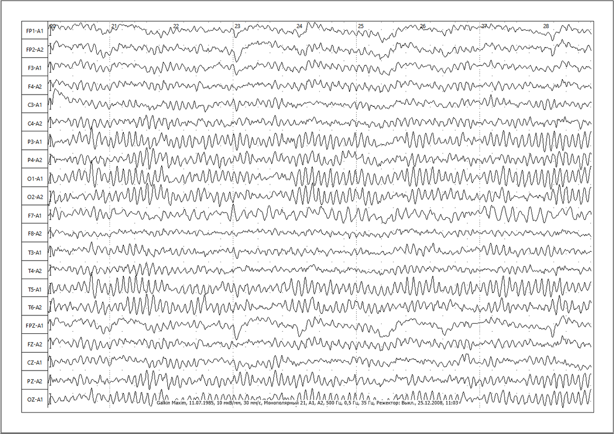 Современное программное обеспечение для регистрации и анализа ЭЭГ |  Электроэнцефалография | Дзен