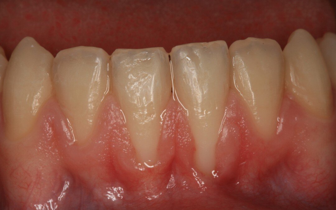 Хроническая форма болезни чаще развивается на фоне острого периода, когда лечение проводилось неправильно или больной игнорировал врачебные предписания. Болезнь отличается слабовыраженными симптомами. Воспаление поражает не только края десны, но и затрагивает десневые сосочки, распространяется на большую часть десны. Сопровождается периодами ремиссии и обострения. Десна увеличиваются в размерах, приобретают красновато-синюшную окраску, часто появляются эрозии, маленькие язвочки.  При  осмотре десен можно заметить большое скопление зубного налета, а причиной тому является то, что больные бояться чистить зубы из-за появления кровоточивости десен и  болезненности. Лечение хронического гингивита предусматривает регулярный уход за ротовой полостью и зубами, применение антисептических растворов для полоскания. Основной целью терапии считается снизить риск и частоту обострений.