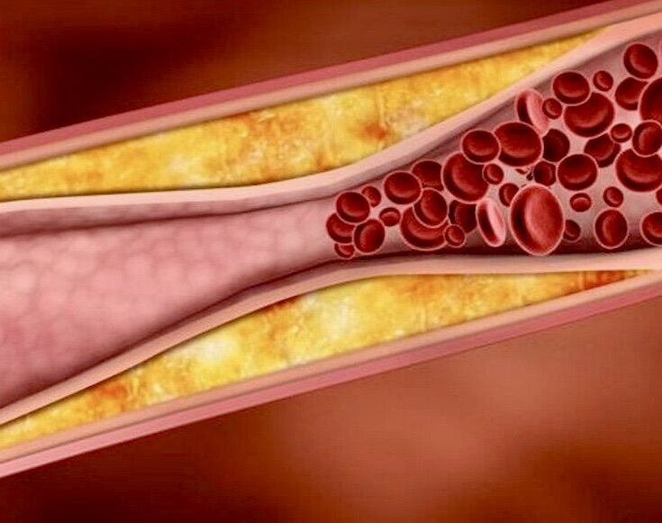 Холестерин закупоривает сосуды