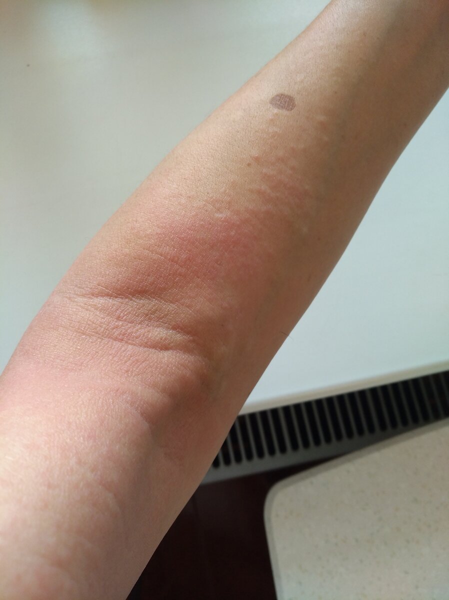 из личного архива. моя аллергия.