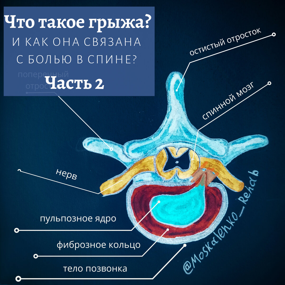 Схематичное изображение компрессии спинномозгового нерва грыжей диска