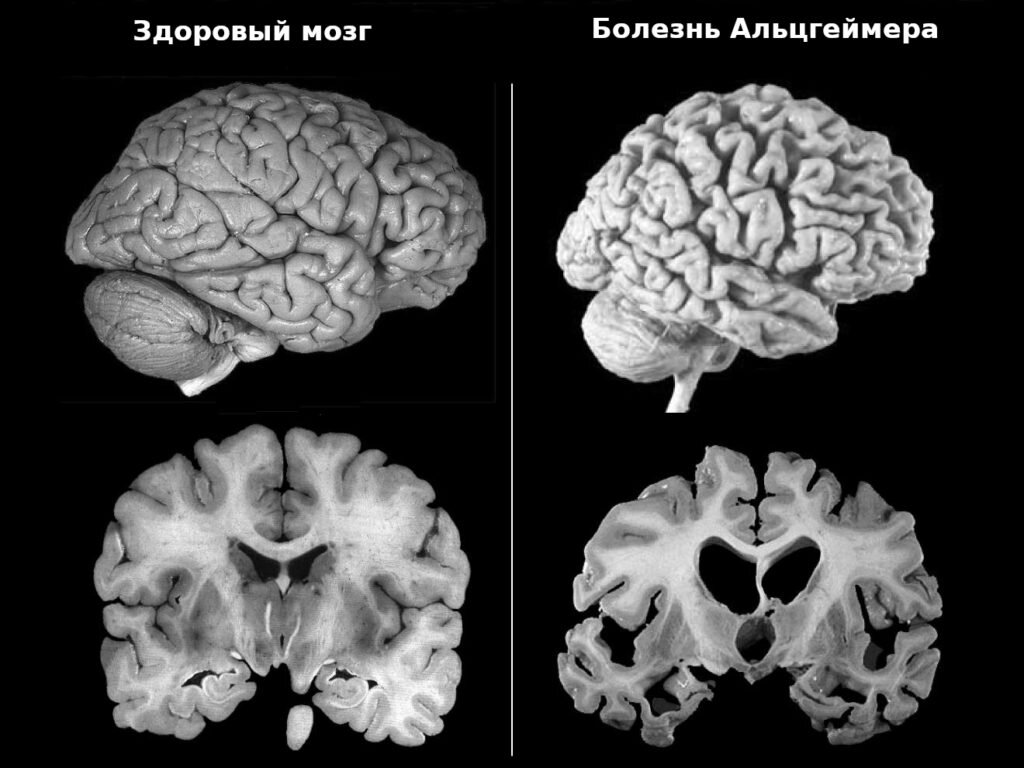 Болезнь Альцгеймера принадлежит к заболеваниям, накладывающим самый тяжёлый финансовый груз на общество в развитых странах.