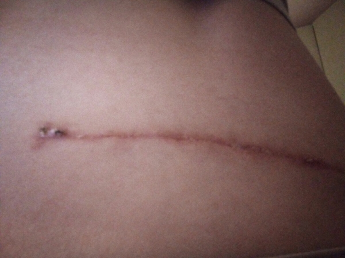 рубец 15 см после широкого иссечения тканей в месте диагностирования меланомы кожи.