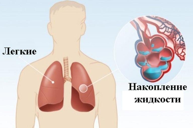 Если легких жидкость что можно. Жидкость в альвеолах легких. Накопление жидкости в легких.