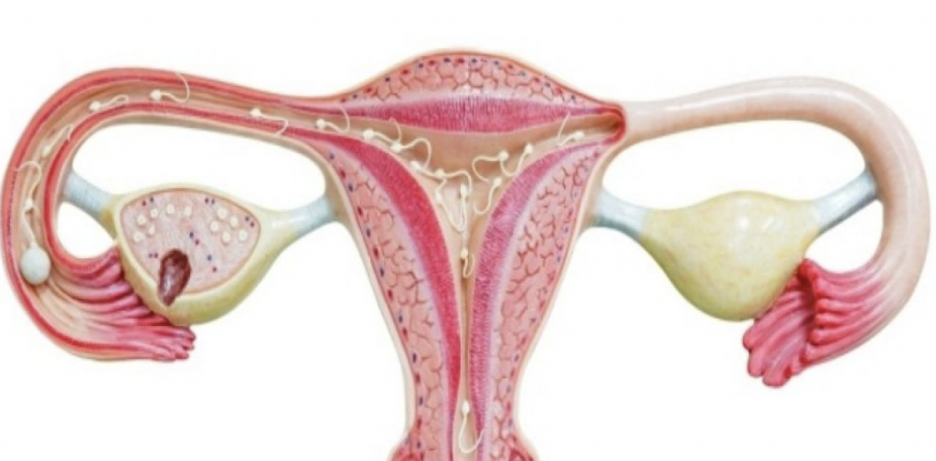 Яичники у женщин цена. Эндометриоидная киста яичника. Эндометриоидная киста яичника гистология. Разрыв эндометриоидные кисты.