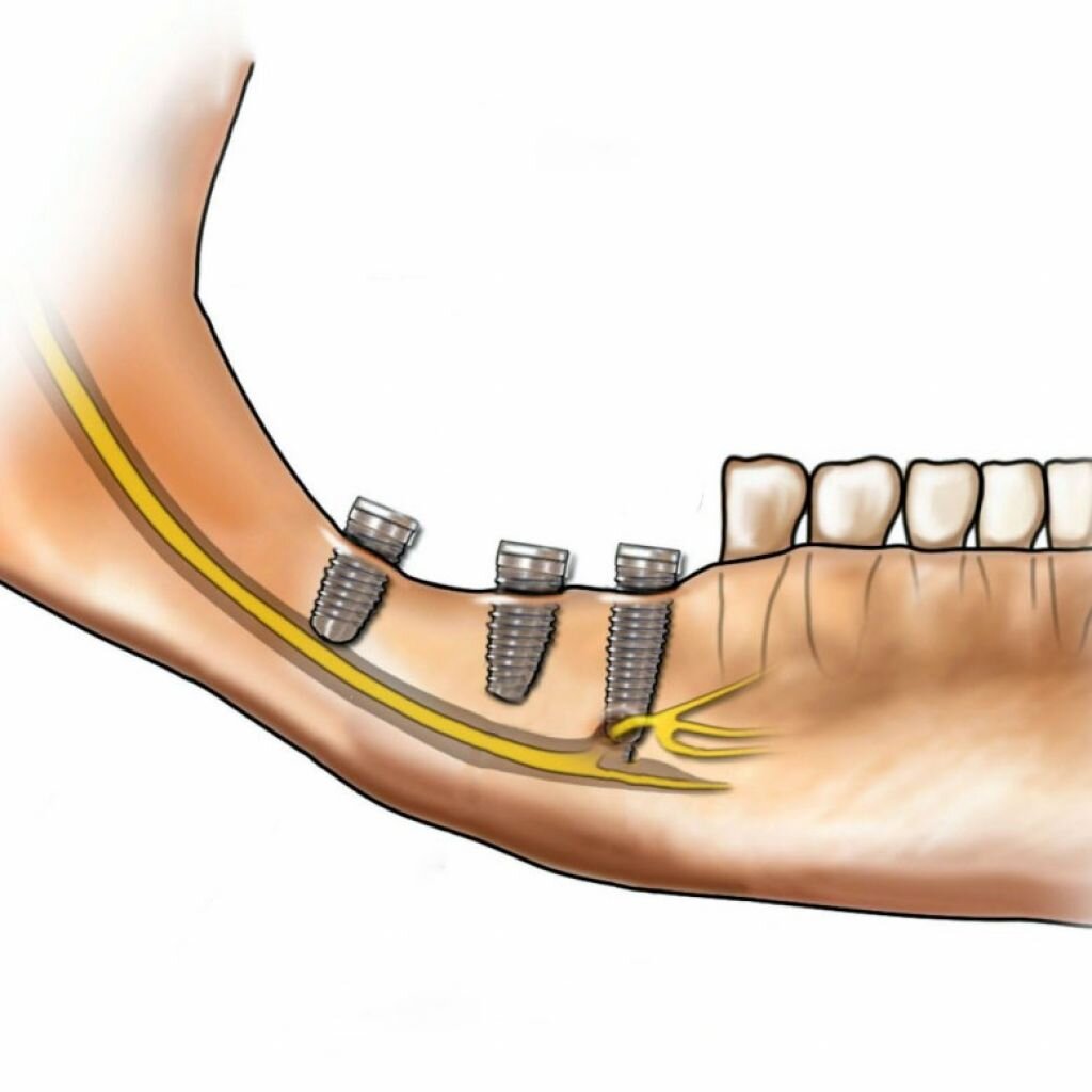 Повреждение нерва при имплантации. Повреждение нерва при имплантации. Немеет губа после имплантации зуба. Повреждение нерва при имплантации. Щечная анестезия методика.