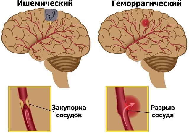 Изменения в тканях мозга после ОНМК