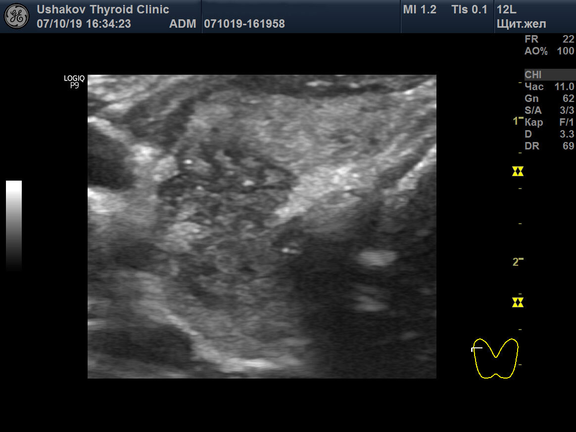 Рак щитовидки на узи. Медуллярная карцинома щитовидной УЗИ. Ti rads 2 щитовидной железы. Ti-rads2 УЗИ щитовидной.