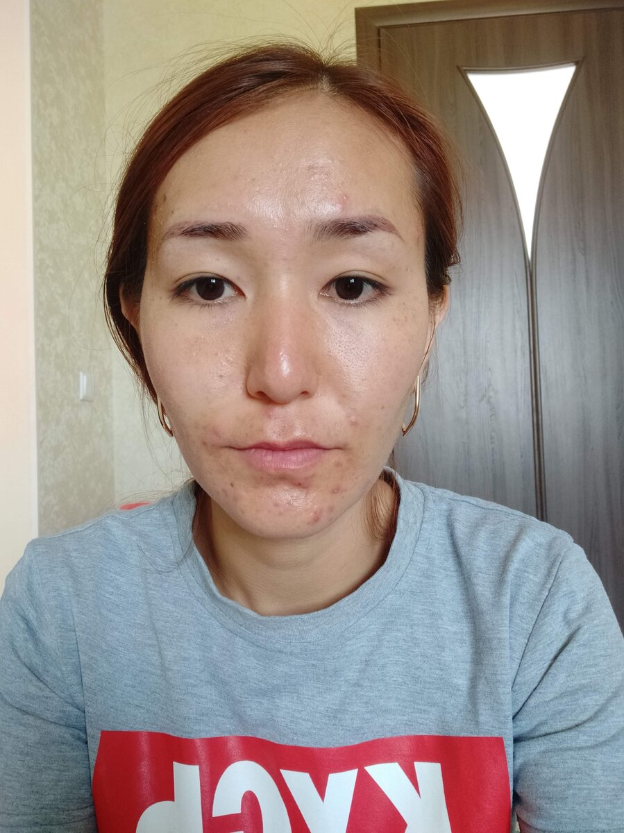 Состояние кожи до начала лечения