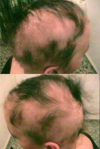 Мария , 24 года, была старожил испанского форума о волосах, пользовалась Миноксидилем , и всем что предлагалась на форуме , была очень настроена против меня , так как уже никому не верила , уехала с очень хорошими результатами и до сих пор дружим.