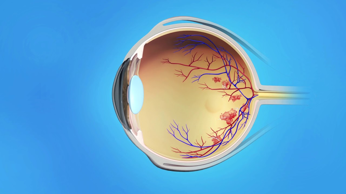 Диабетическая ретинопатия глазное дно. Диабетическая микроангиопатия ретинопатия жалобы. Заболевания глаз при сахарном диабете. Осложнения сахарного диабета ретинопатия. Диабетическая ретинопатия изменения глазного дна.