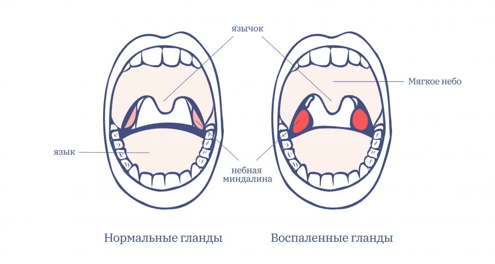 Миндалины схема расположение