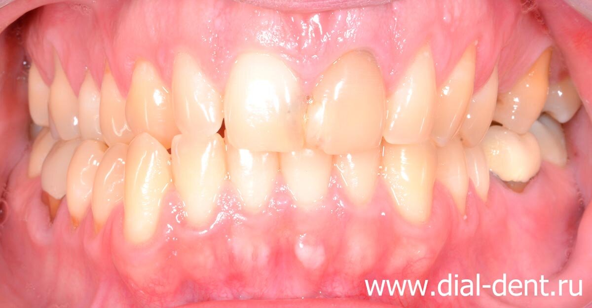 неправильный прикус стал причиной выпадения пломб, возникновения клиновидных дефектов и частого кариеса