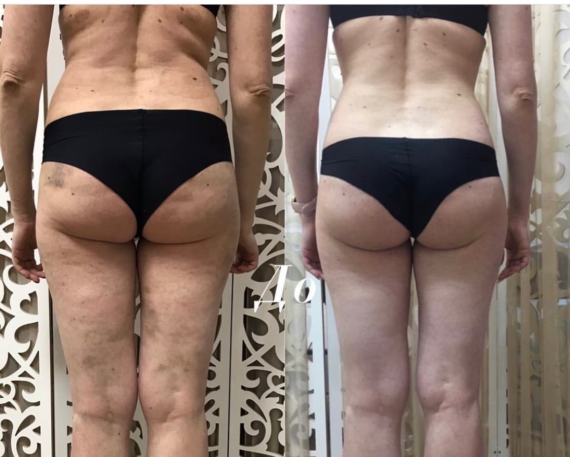 Результат после 8 сеансов