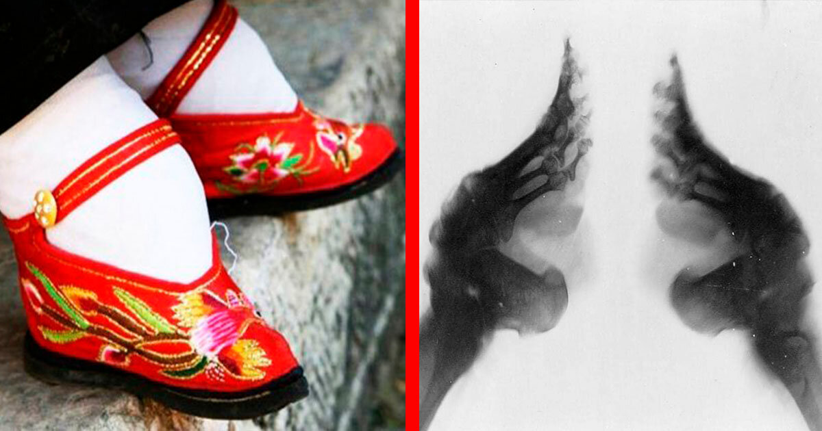 Институт бинтования ног расценивался как необходимый и прекрасный, практикующийся аж десять веков. Редкие попытки «освобождения» ступни все же предпринимались, однако противившиеся обряду были белыми воронами. 