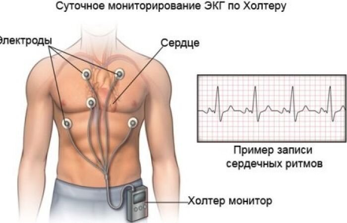 Проведение холтеровского мониторирования