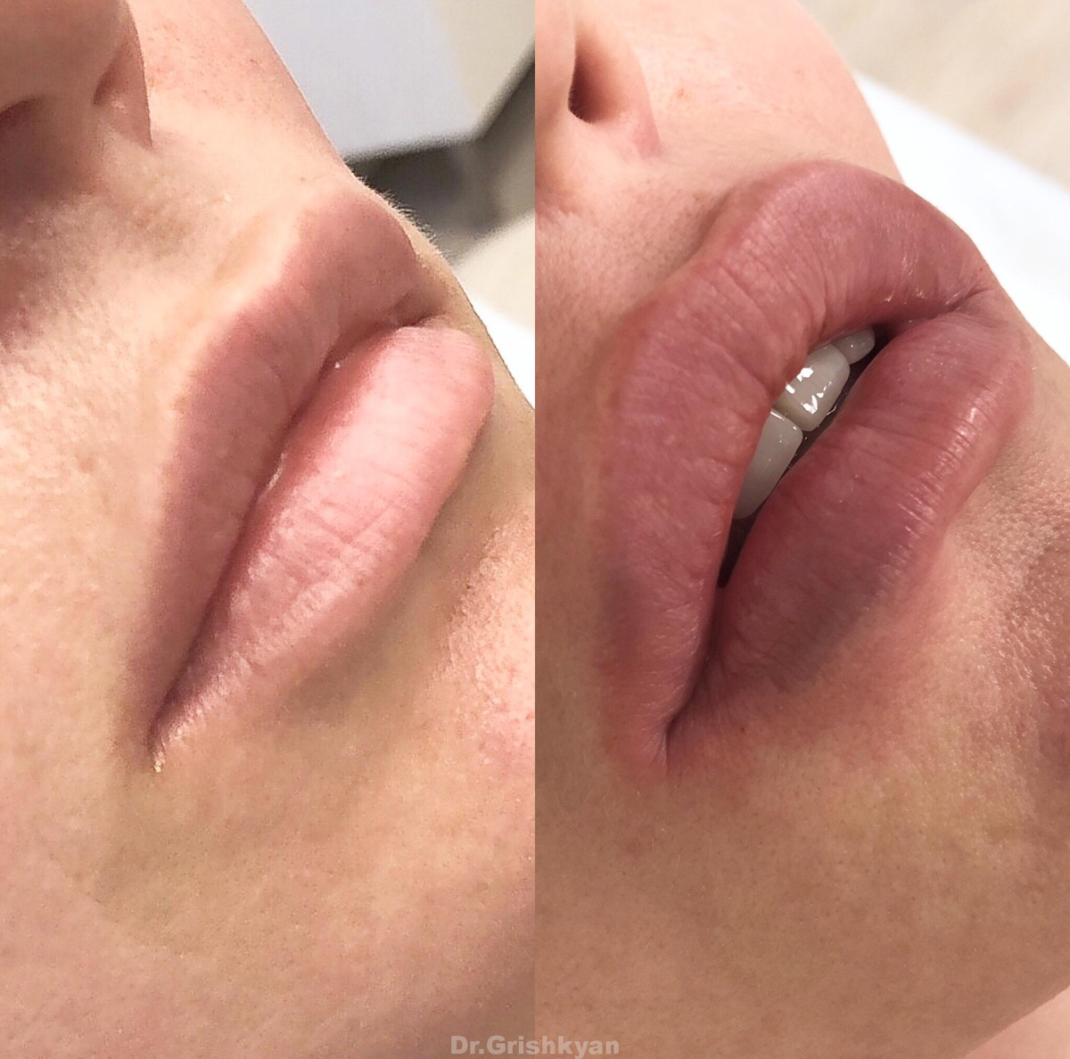 Фото с сайта хирурга Д.Р,Гришкяна, имеются противопоказания, требуется консультация специалиста. 