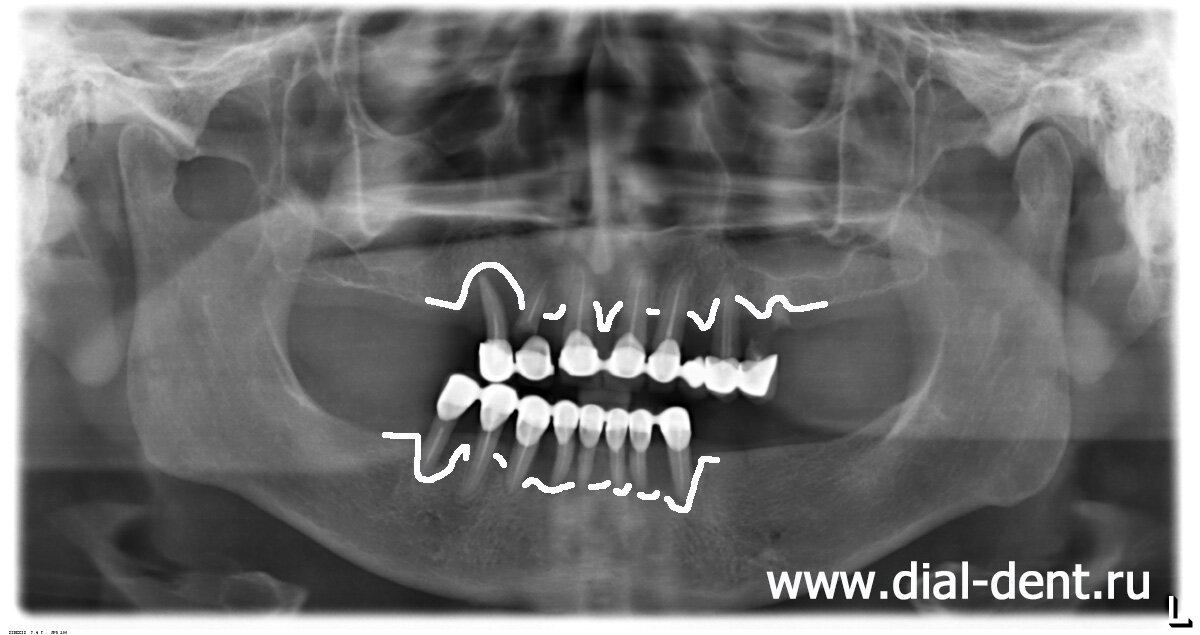 из-за пародонтита снижен уровень кости