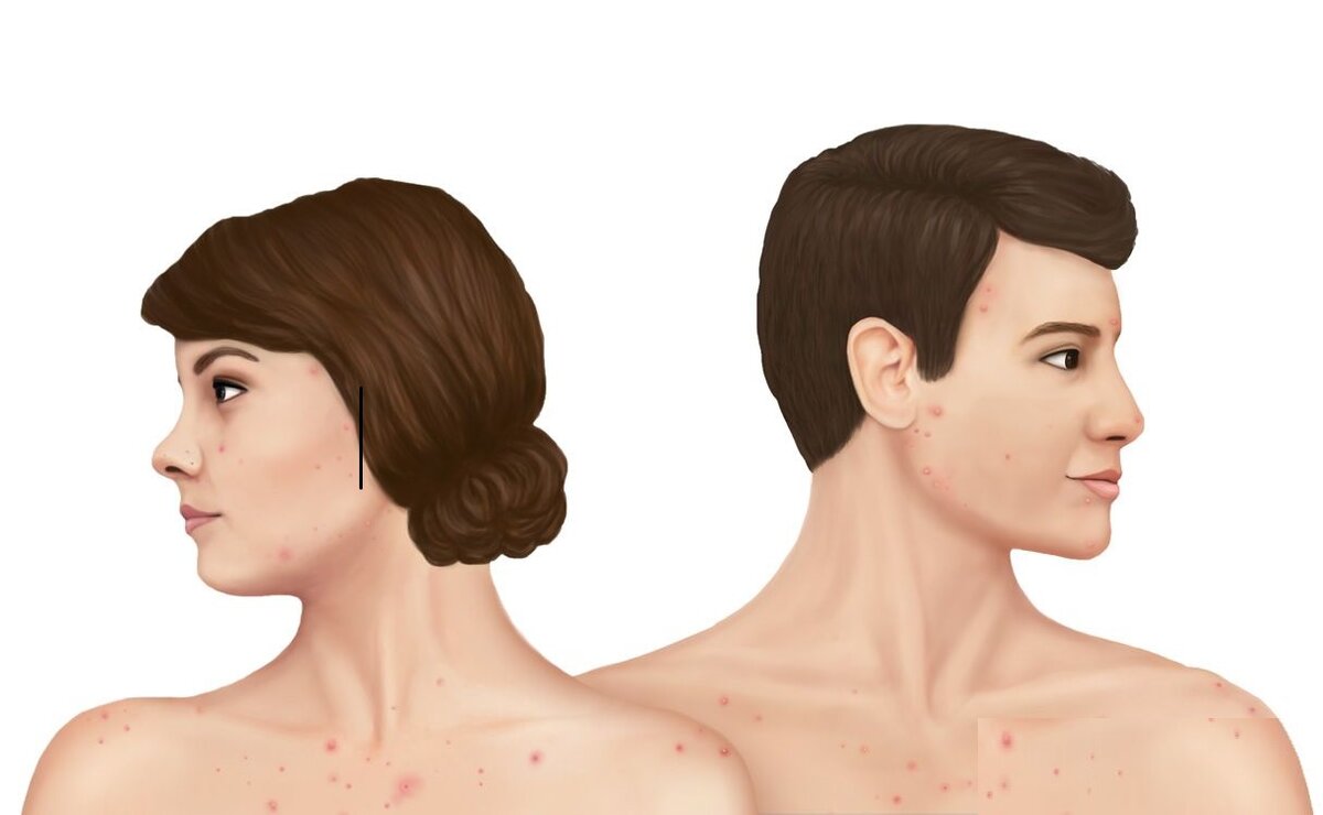 Половой Отбор Объясняет, Почему Акне Остается Здесь Навсегда