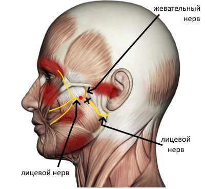 Схема операции при параличе лицевого нерва