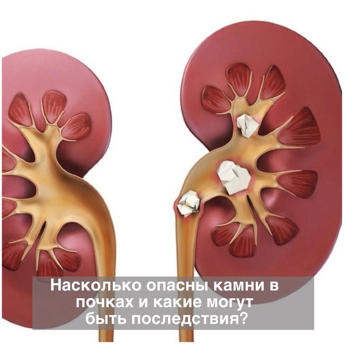 Камни в почках что делать. Коралловидный нефролитиаз. Мочекаменная болезнь (нефролитиаз). Мочекаменная Почечнокаменная болезнь. Почечнокаменная болезнь