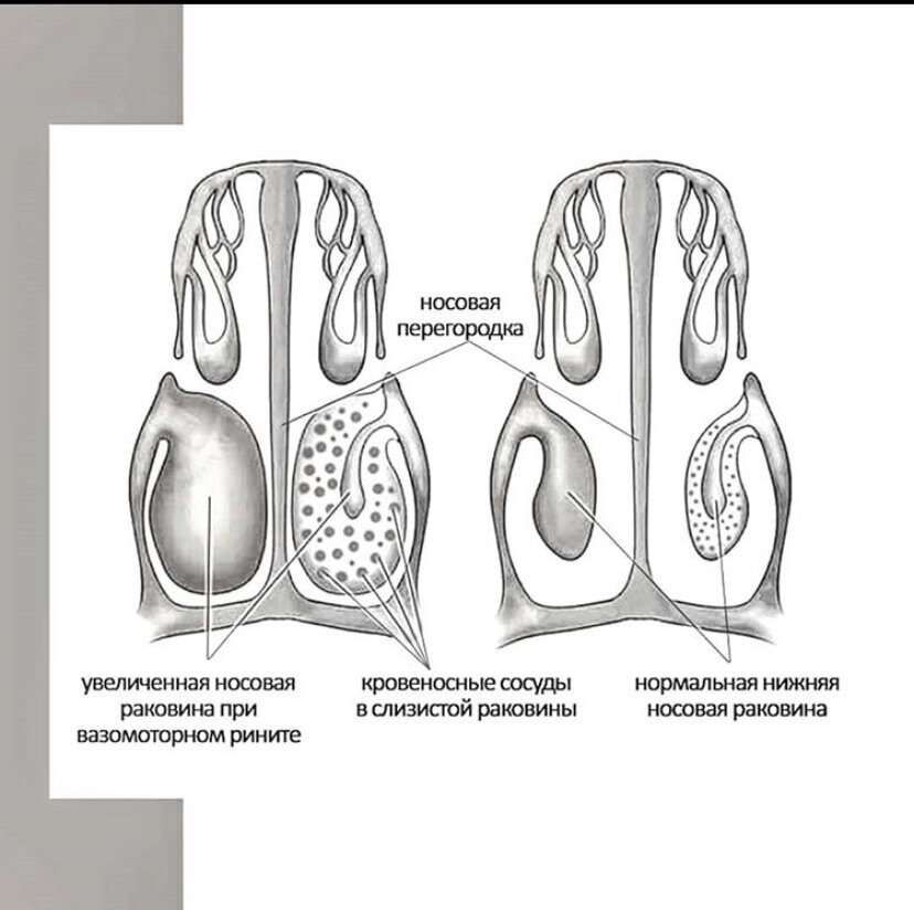 Вазомоторный ринит носовые раковины. Слизистая носа вазомоторный ринит. Нижняя носовая раковина рентген.