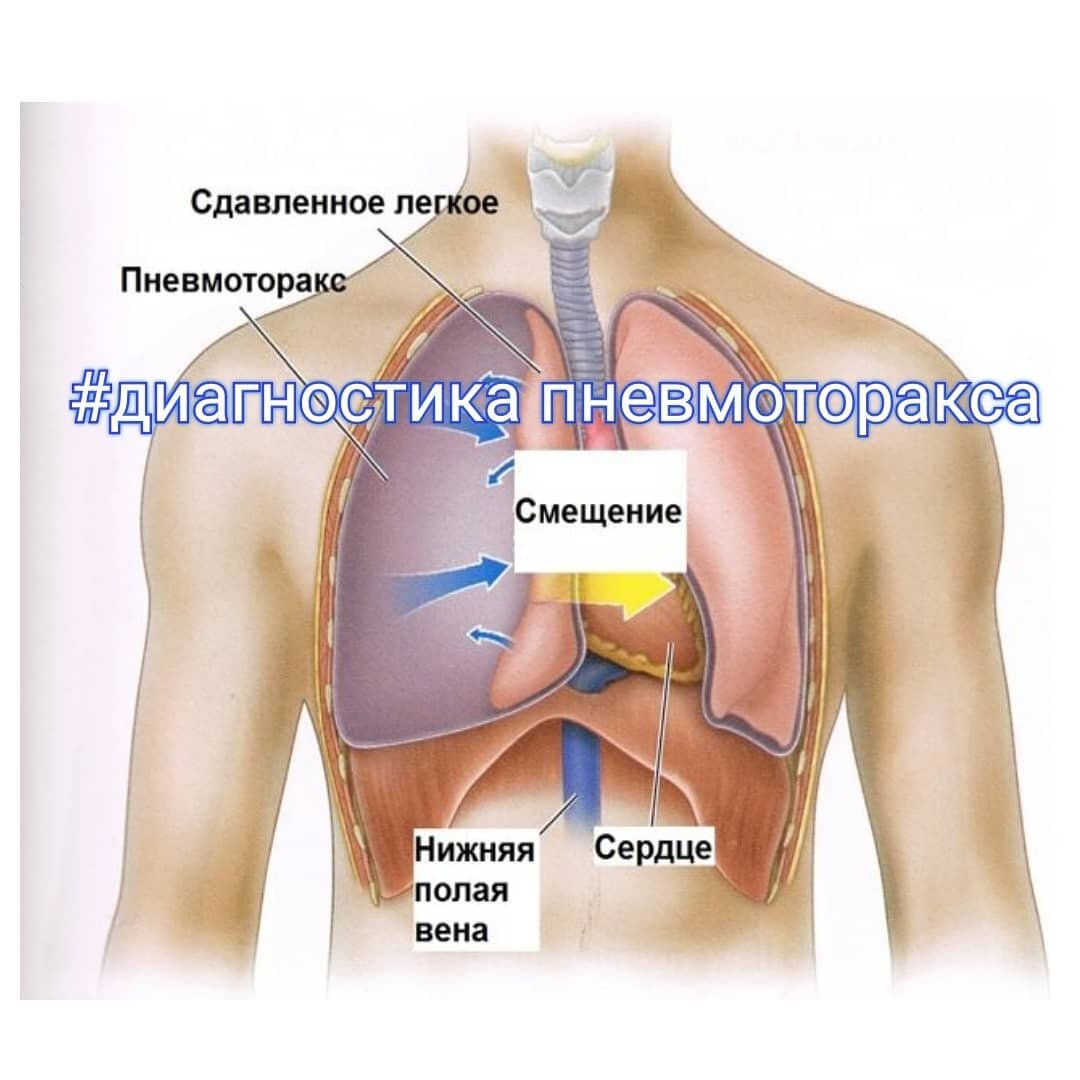 спонтанный пневмоторакс. статическое и динамическое сопротивление дыхания. пневмоторакс сердца. пневмоторакс плевральная жидкость. пневмоторакс сердца.