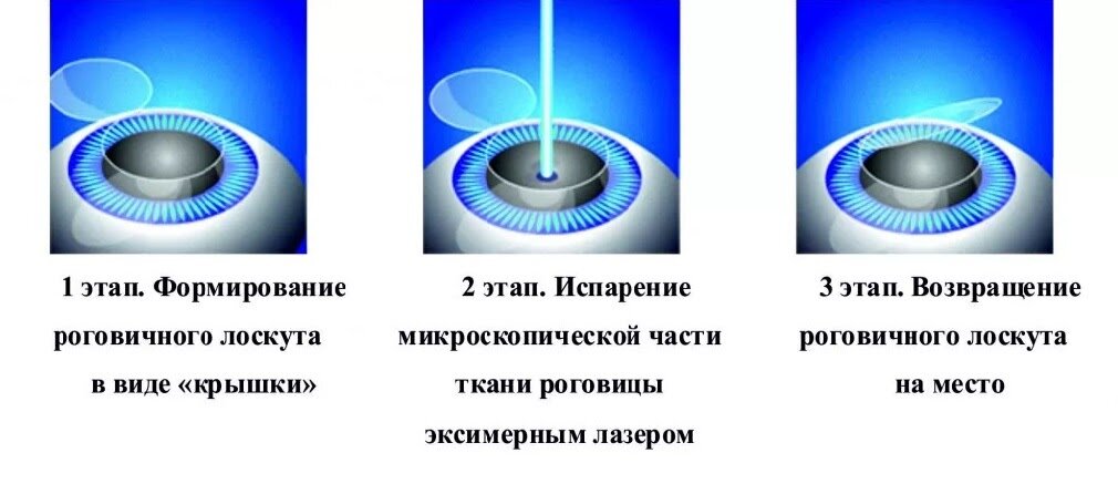 Схематичное изображение коррекции методом Lasik (источник http://www.eye-kaluga.com/patients/vision_correction/lasik)