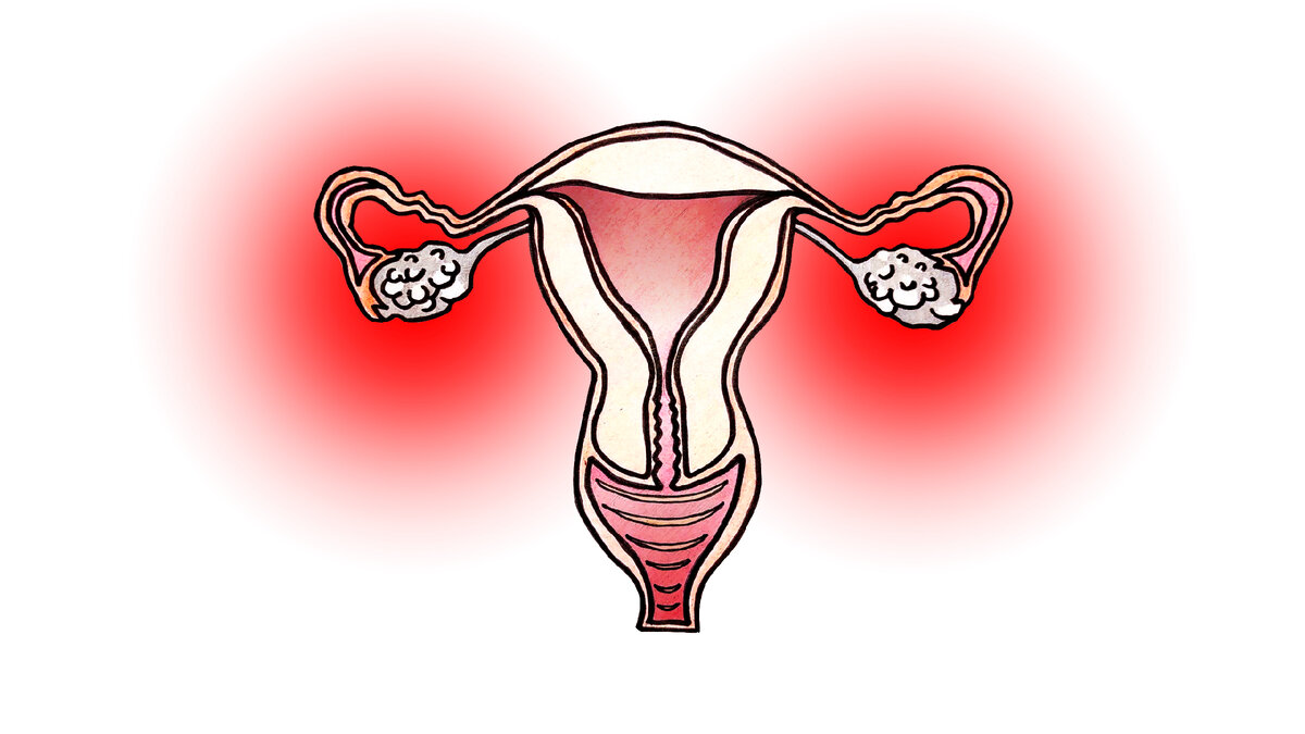 Рисунок 1- Женская половая система с СПКЯ.