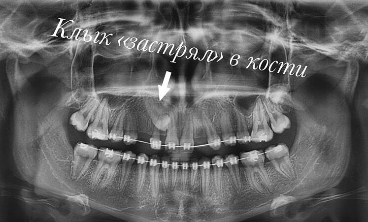 А с правой стороны клык «застрял» в кости, и нужна ортодонтическая помощь по вытяжению. 