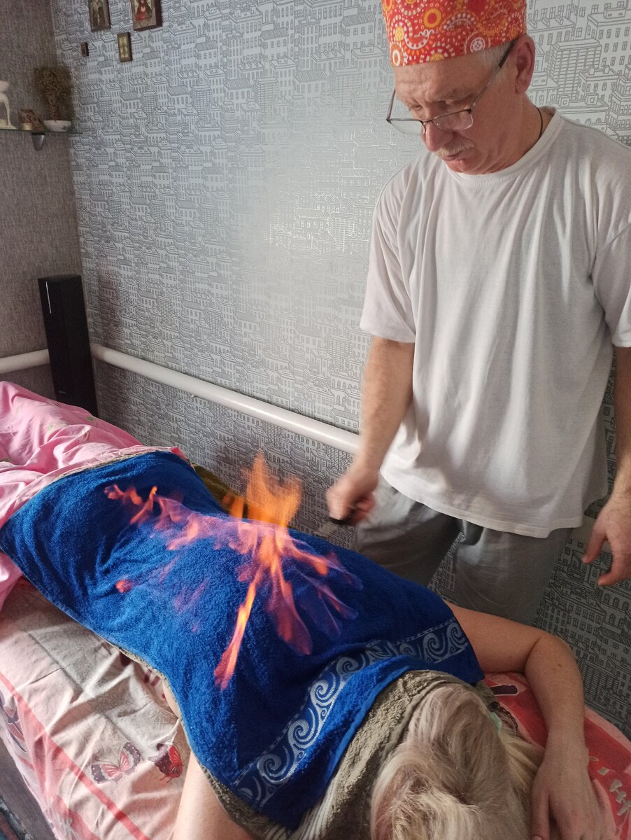Прожигание огнем
