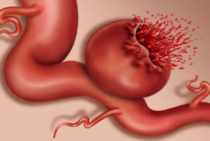 Аневризма сосуда