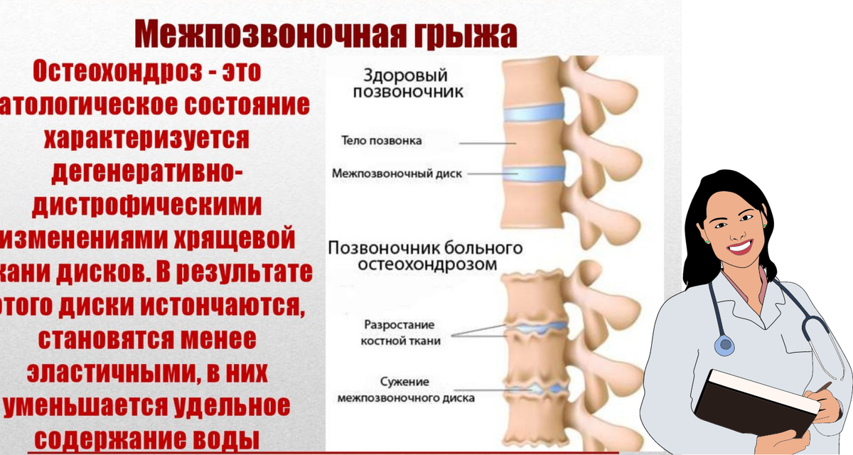 Симптомы межпозваночной грыжи  (фото из открытых источников)