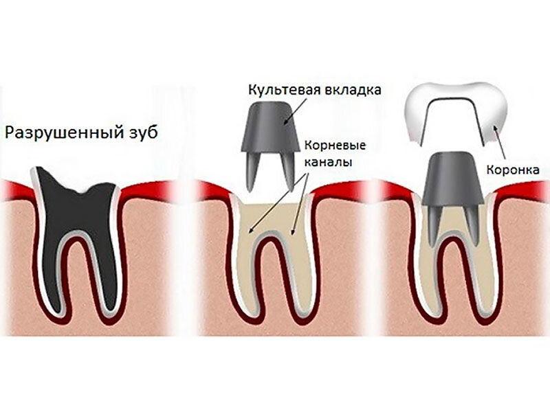 Под коронкой. Культевая вкладка штифт зуб. Штифтово культевая конструкция.