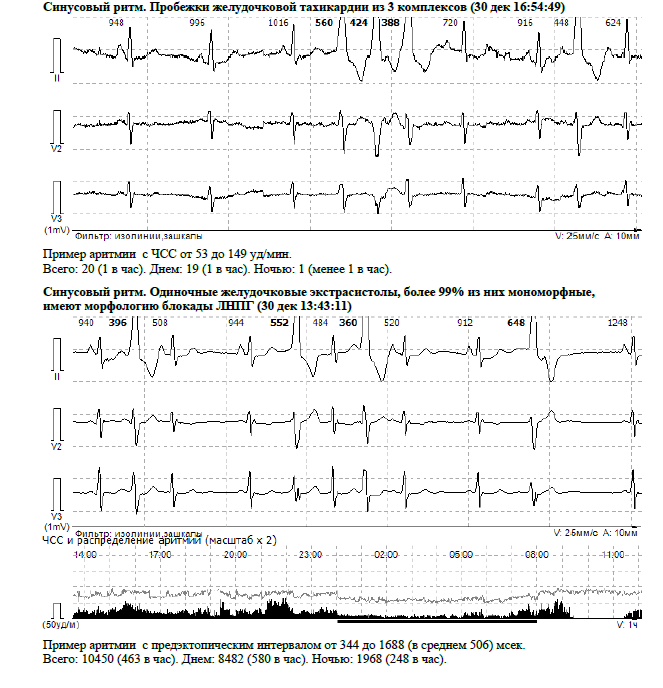 Из-за большой межсуточной вариабельности числа экстрасистол уменьшение их количества даже в 2-3 раза на самом деле ни о каком эффекте не говорит. Что я здесь и увидел: эффекта на самом деле нет! Хотя экстрасистол по сравнению с максимумом стало в 2,5 раз меньше