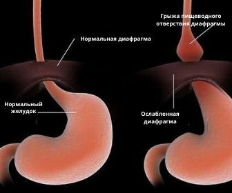  Это не потому, что вы слишком много ели   Если это не беременность и вы не переусердствовали за столом, стоит обратить внимание, когда живот часто распирает.-2