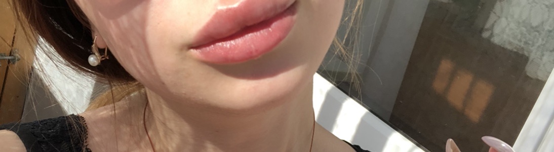 Состояние губ сразу после процедуры 