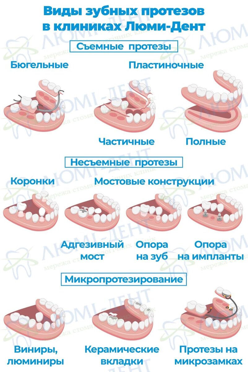 виды зубных протезов и мостов